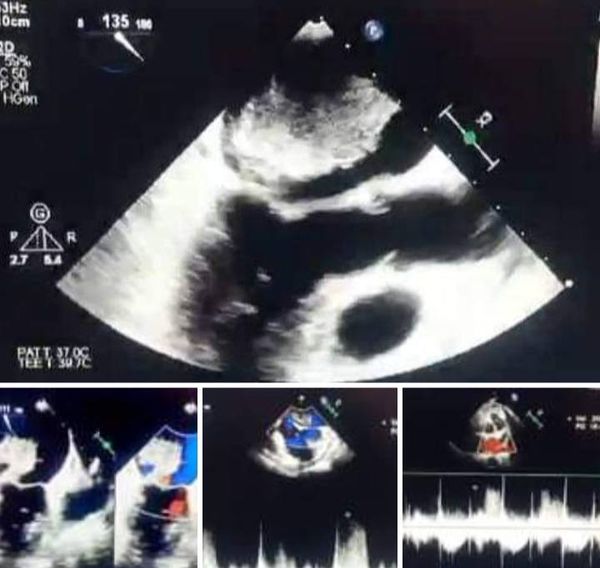 A medical team at Assiut University Heart Hospital succeeds in saving the life of a patient suffering from a heart tumor