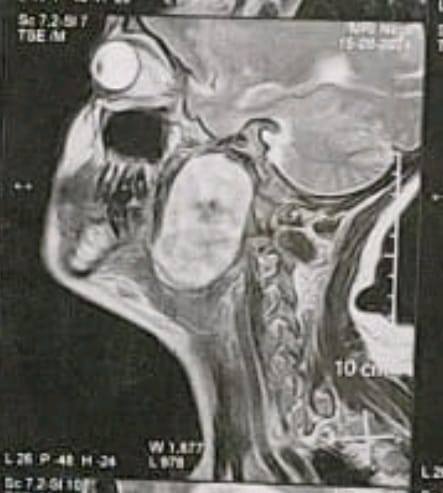 A medical team in the Department of Ear, Nose and Throat Surgery at Assiut University Hospitals succeeds in removing a tumor in the parotid gland extending to the bottom of the skull through a small incision instead of breaking the lower jaw to reach the tumor.
