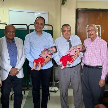 A new achievement for Assiut University in a rare operation to separate conjoined twins at the University Children's Hospital